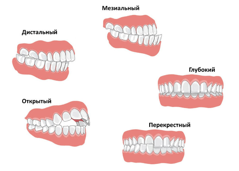 Как меняется прикус в процессе роста и что считается нормой
